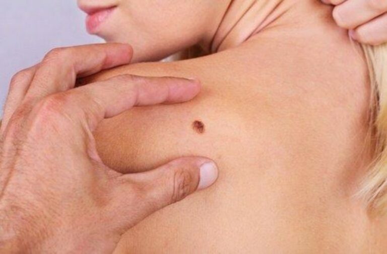 Δωρεάν εξετάσεις για την πρόληψη του καρκίνου του δέρματος