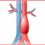 aneyrusma-aortis-01